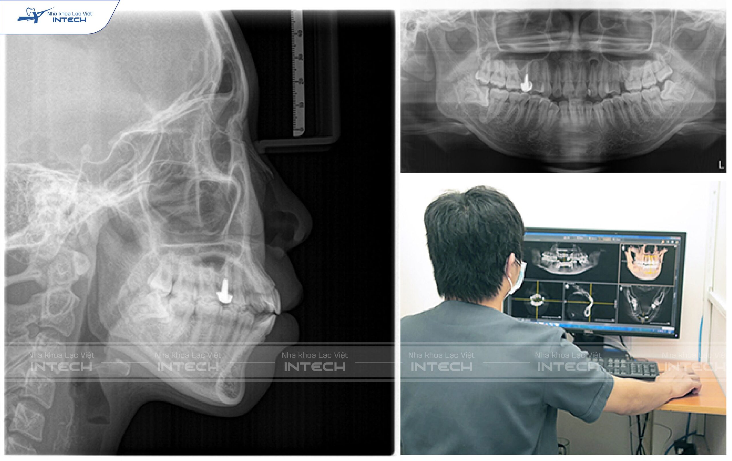 Chụp Xquang dễ nhận biết được răng gặp xương hàm mỏng hay không?