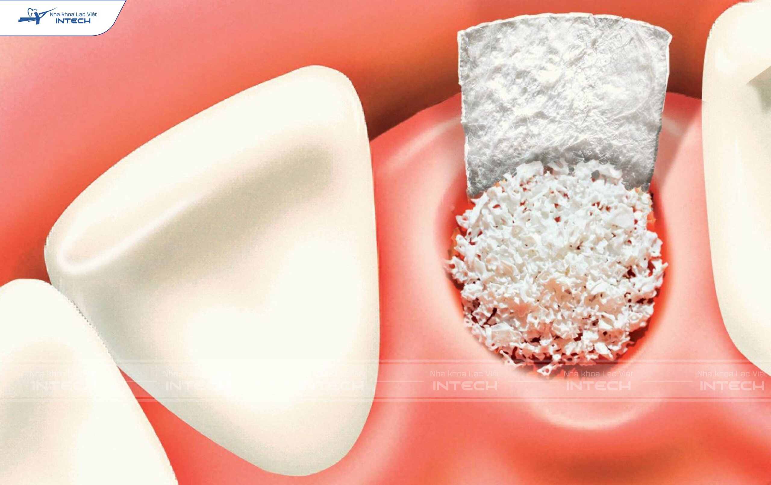 Rủi ro tiêu chân xương khi niềng răng xương hàm mỏng