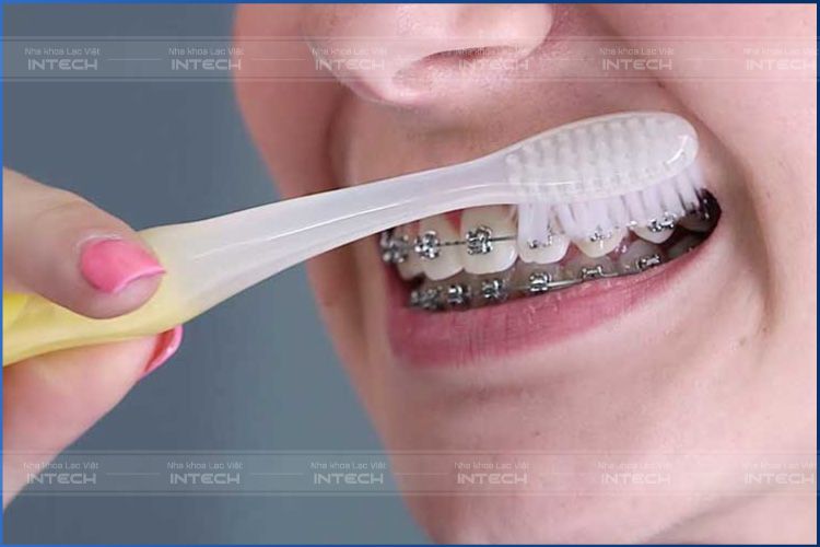 Chăm sóc vệ sinh răng miệng khi niềng răng rất quan trọng