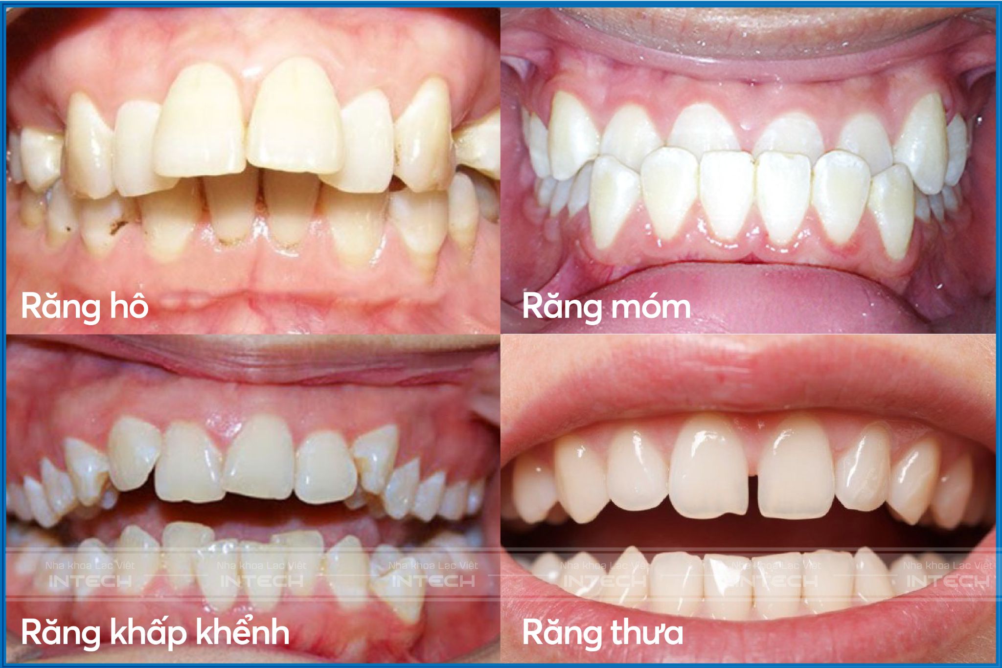 Niềng răng mặt lưỡi khắc phục mọi tình trạng sai lệch về răng