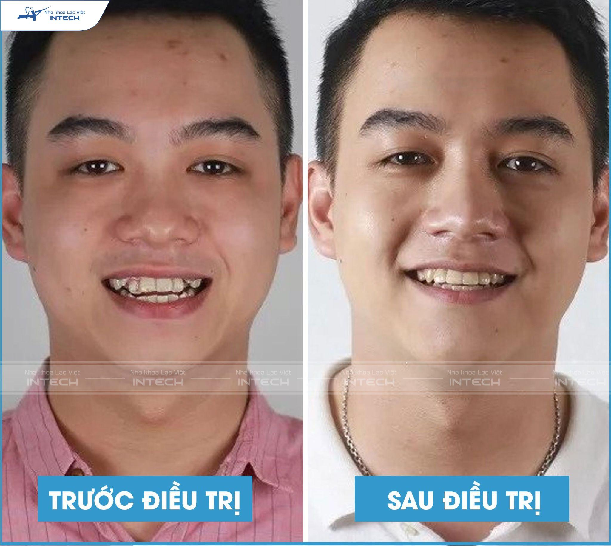 Hình ảnh khách hàng thay đổi sau khi niềng răng trong suốt tại Lạc VIệt Intech