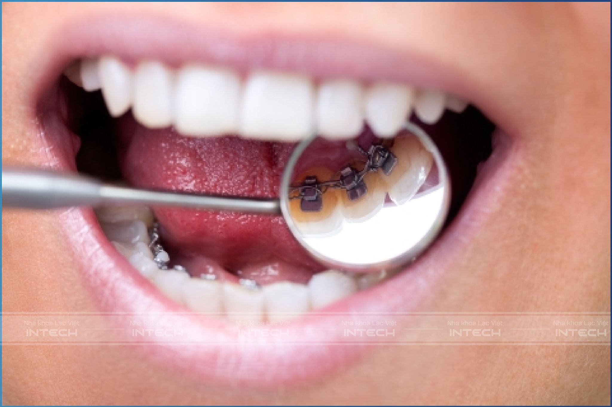 Khí cụ chỉnh nha được giấu kín bên trong răng