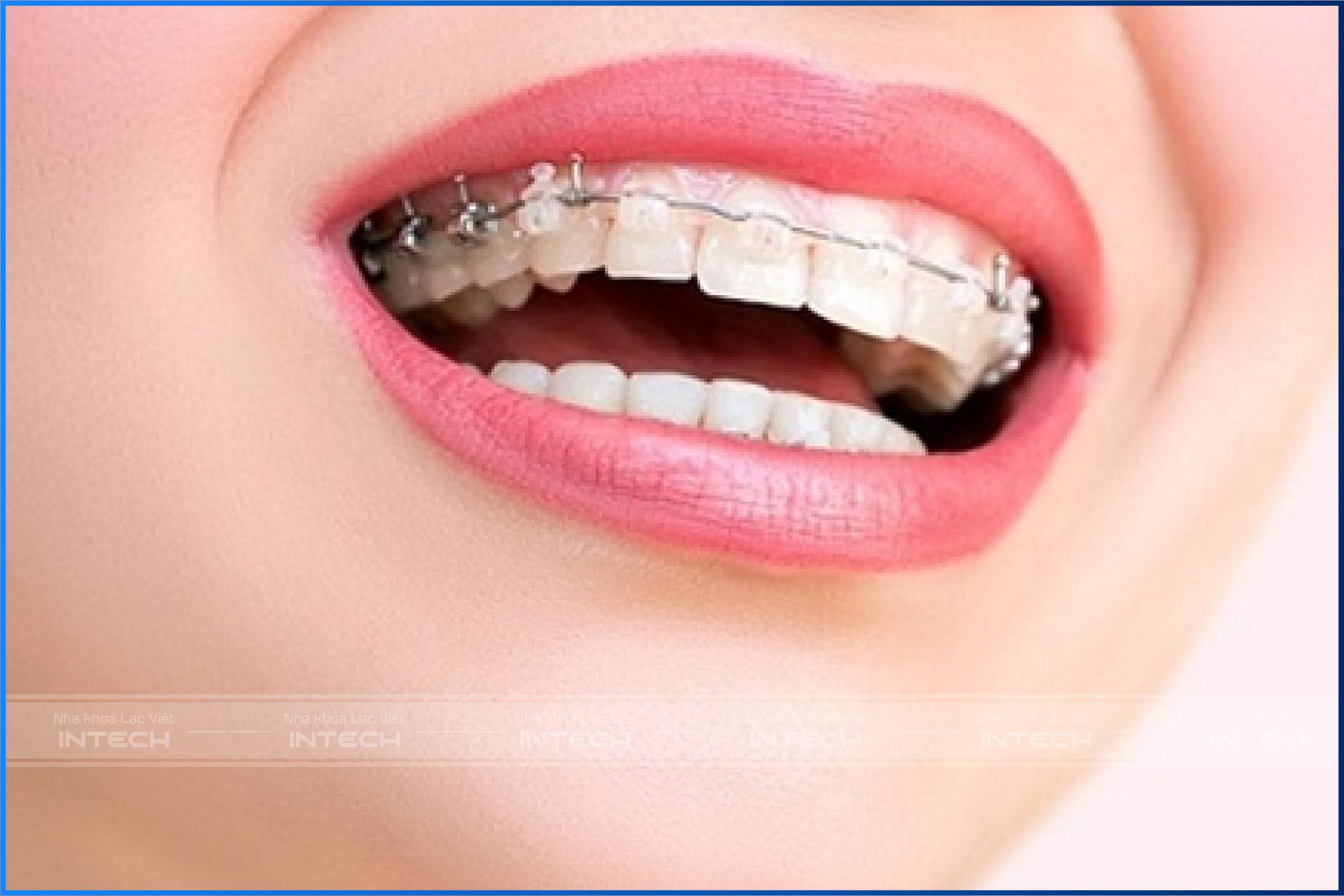 Có thể niềng răng 1 hàm nếu bạn chỉ bị sai lệch hàm trên hoặc hàm dưới