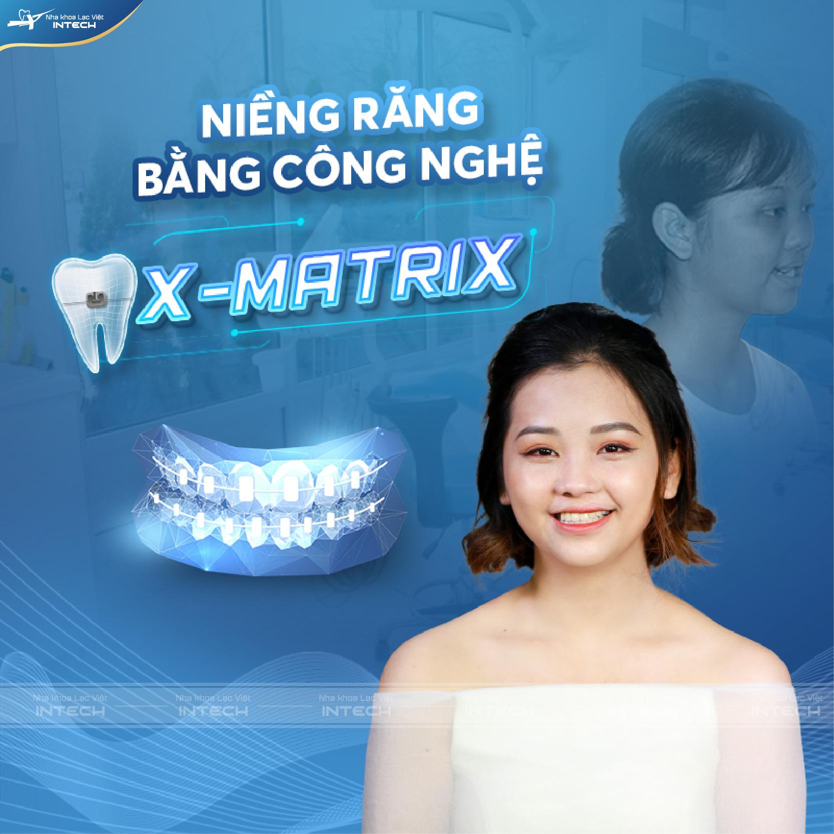 Niềng răng bằng công nghệ X- Matrix