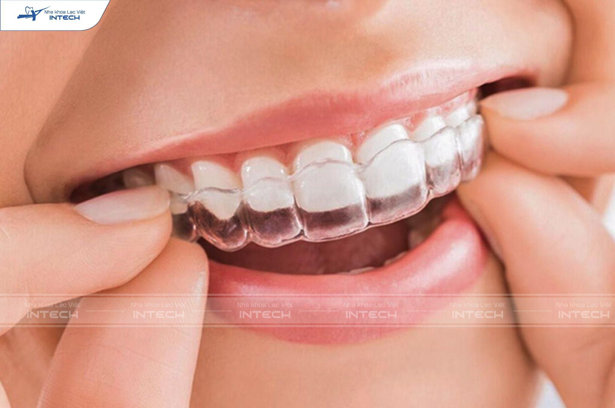 Niềng răng trong suốt còn được gọi là niềng răng khay trong 