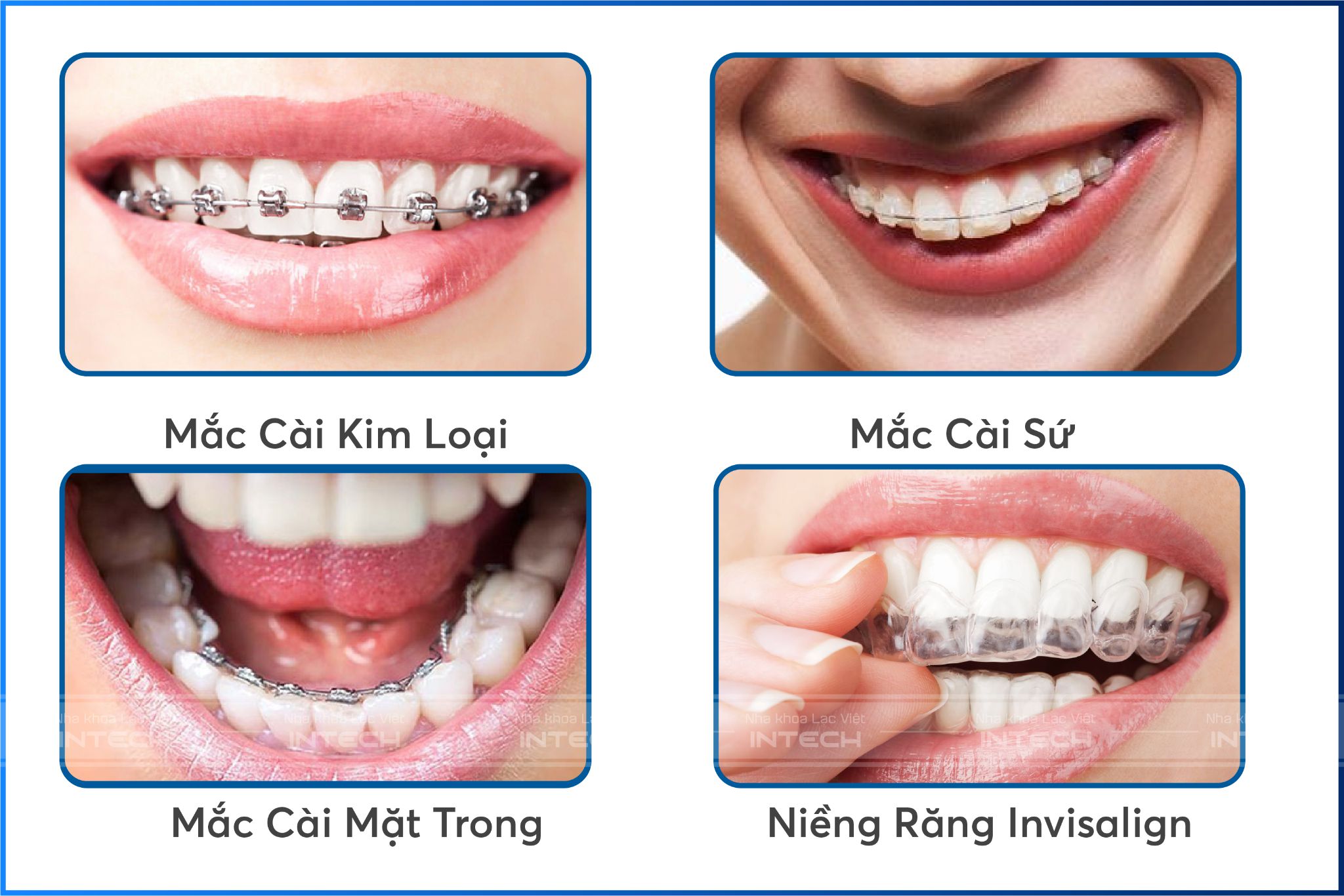 Các phương pháp chỉnh nha phổ biến nhất hiện nay