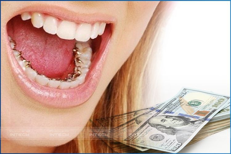 Niềng răng mặt trong có nhược điểm là chi phí khá cao. Niềng răng mặt trong có nhược điểm là chi phí khá cao.