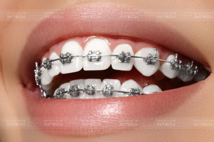 Niềng răng là phương pháp an toàn nhất giúp bạn có hàm răng đều đẹp