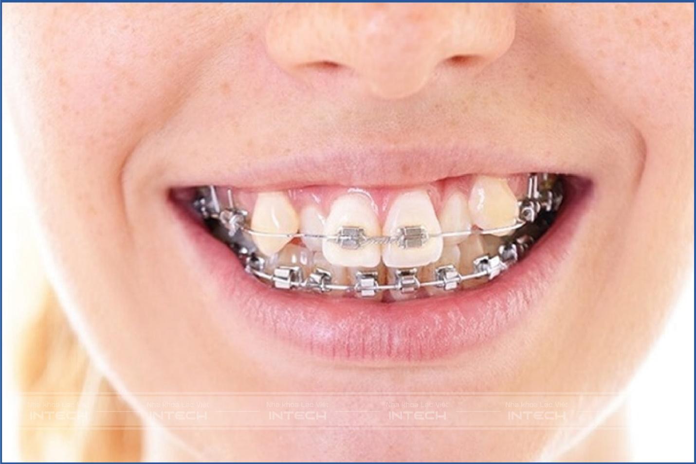 Niềng răng hoàn toàn có thể giữ lại răng khểnh, tuy nhiên bạn cần cân nhắc thật kỹ