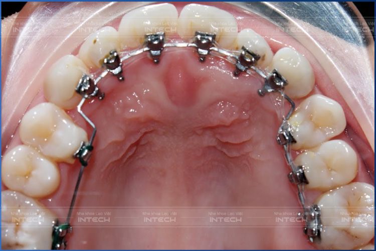 Niềng răng mặt trong được gắn bên trong thân răng. Niềng răng mặt trong được gắn bên trong thân răng.