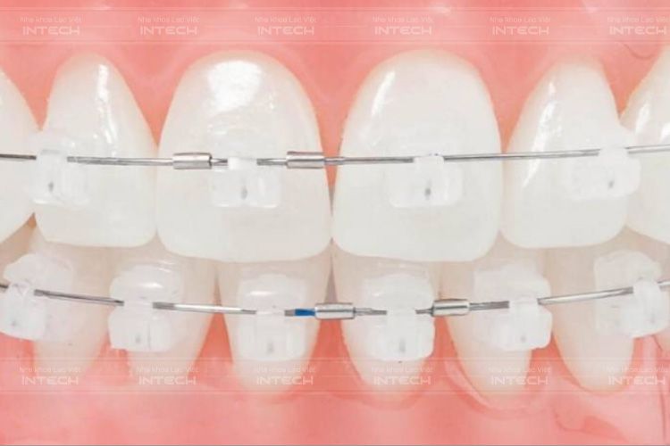 Niềng răng mắc cài sứ có thể áp dụng trong trường hợp muốn giữ lại răng khểnh khi niềng