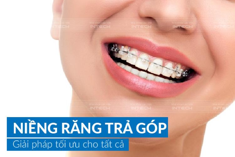 Niềng răng trả góp – Giải pháp tối ưu giảm áp lực tài chính Niềng răng trả góp – Giải pháp tối ưu giảm áp lực tài chính