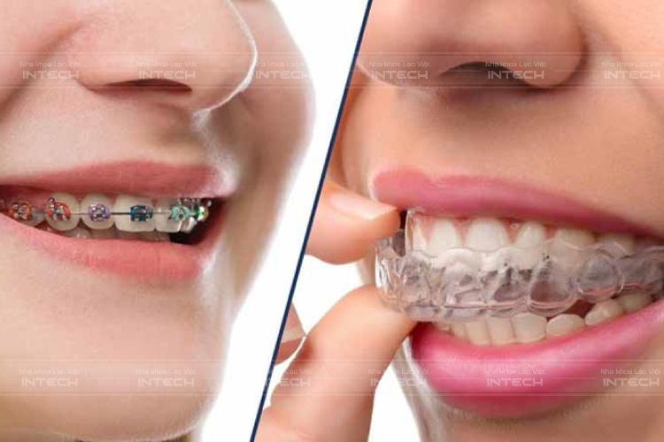Niềng răng trả góp là dịch vụ phổ biến được áp dụng cho mọi phương pháp niềng Niềng răng trả góp là dịch vụ phổ biến được áp dụng cho mọi phương pháp niềng