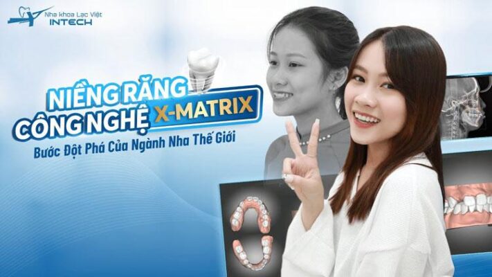 Công nghệ niềng răng X-Matrix giúp rút ngắn thời gian điều trị