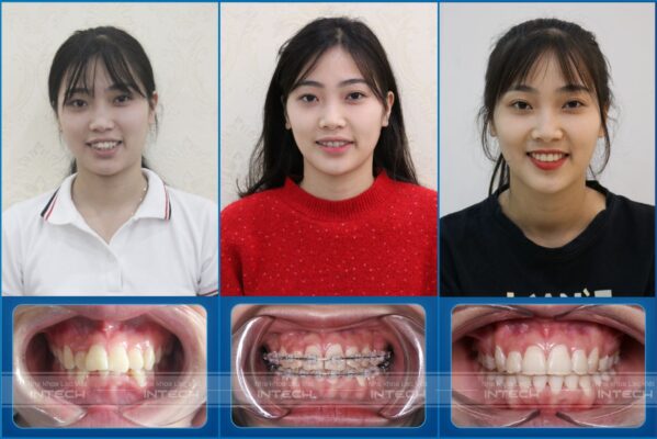 Hành trình thay đổi của Xen khi niềng răng tại Lạc Việt Intech