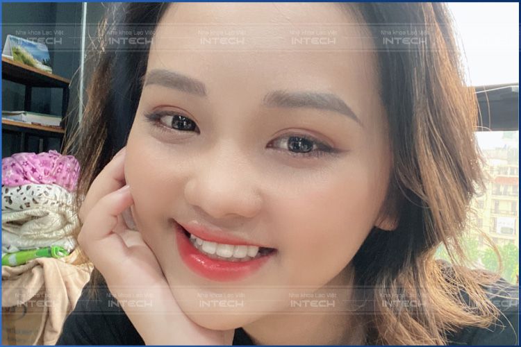 Lựa chọn niềng răng mắc cài kim loại tại Lạc Việt Intech đã giúp Đinh Thị Giang có được nụ cười mới, tự tin và rạng rỡ hơn. Lựa chọn niềng răng mắc cài kim loại tại Lạc Việt Intech đã giúp Đinh Thị Giang có được nụ cười mới, tự tin và rạng rỡ hơn.