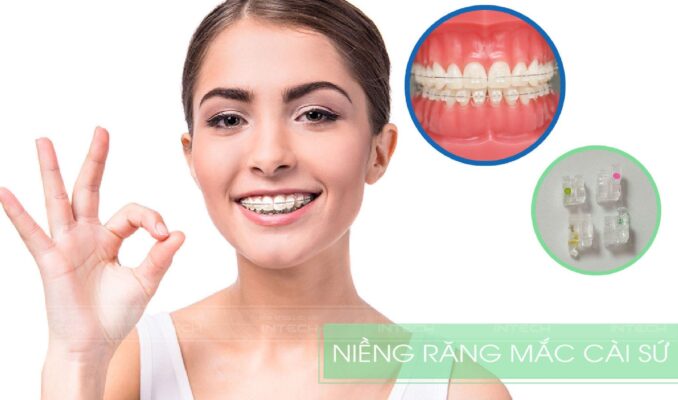 Mắc cài sứ đảm bảo tính thẩm mỹ cho khách hàng trong suốt thời gian niềng răng Mắc cài sứ đảm bảo tính thẩm mỹ cho khách hàng trong suốt thời gian niềng răng
