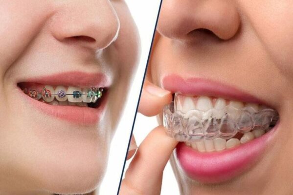 Niềng răng Invisalign giúp tiết kiệm thời gian hơn so với niềng răng mắc cài