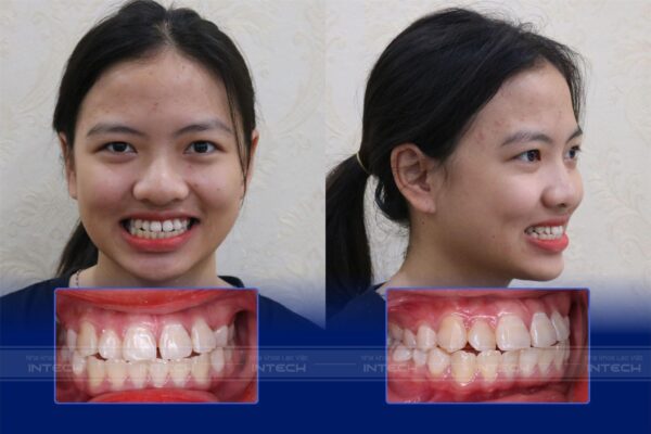 Hình ảnh trước khi niềng răng của Kim Thị Hồng Nhung Hình ảnh trước khi niềng răng của Kim Thị Hồng Nhung