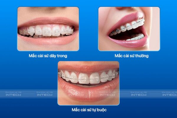 3 phương pháp niềng răng sứ hiện nay 