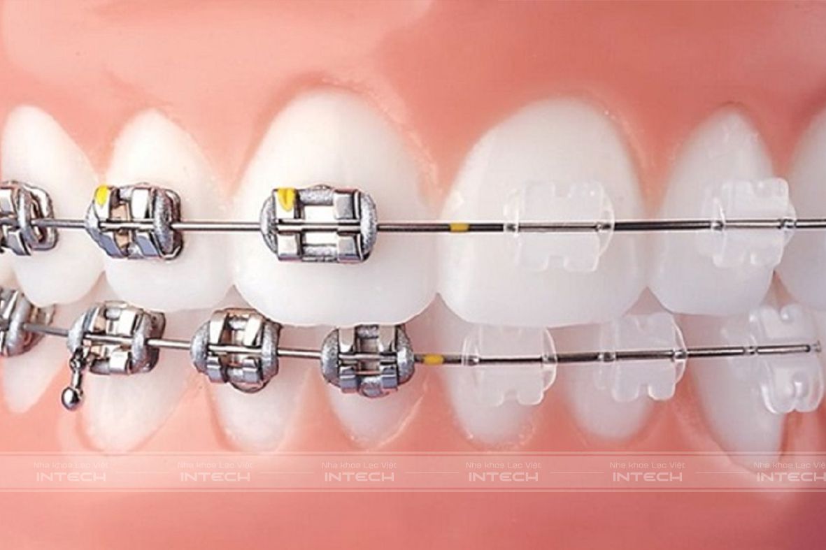 Chất liệu sứ có màu tương đồng với màu răng, đảm bảo tính thẩm mỹ cao