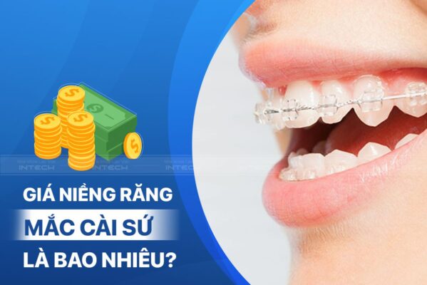 Giá niềng răng mắc cài sứ phụ thuộc nhiều yếu tố