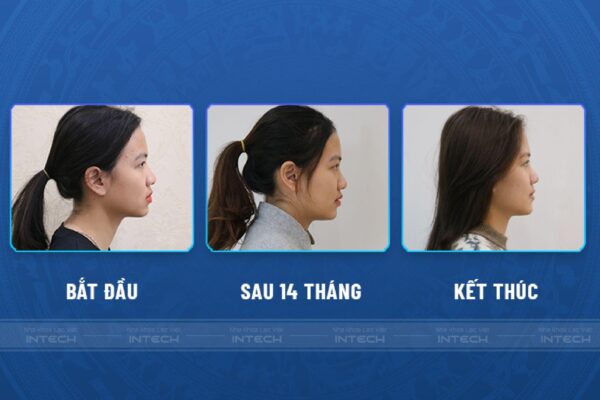 Góc nghiêng “thần thánh” của Hồng Nhung sau 18 tháng niềng răng Góc nghiêng “thần thánh” của Hồng Nhung sau 18 tháng niềng răng