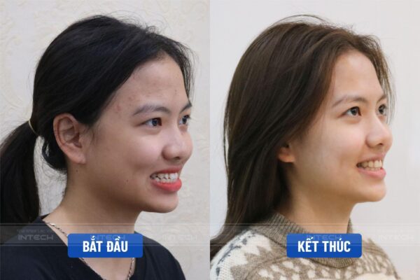 Hình ảnh góc nghiêng thay đổi trở nên thon gọn, giảm hô Hình ảnh góc nghiêng thay đổi trở nên thon gọn, giảm hô