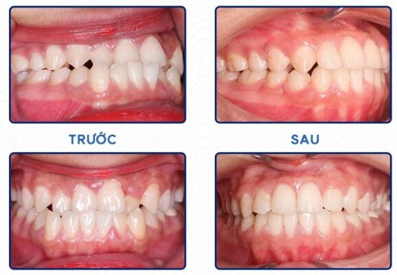 Đây là răng ảnh chụp tình trạng răng của mình sau 24 tháng niềng răng trong suốt