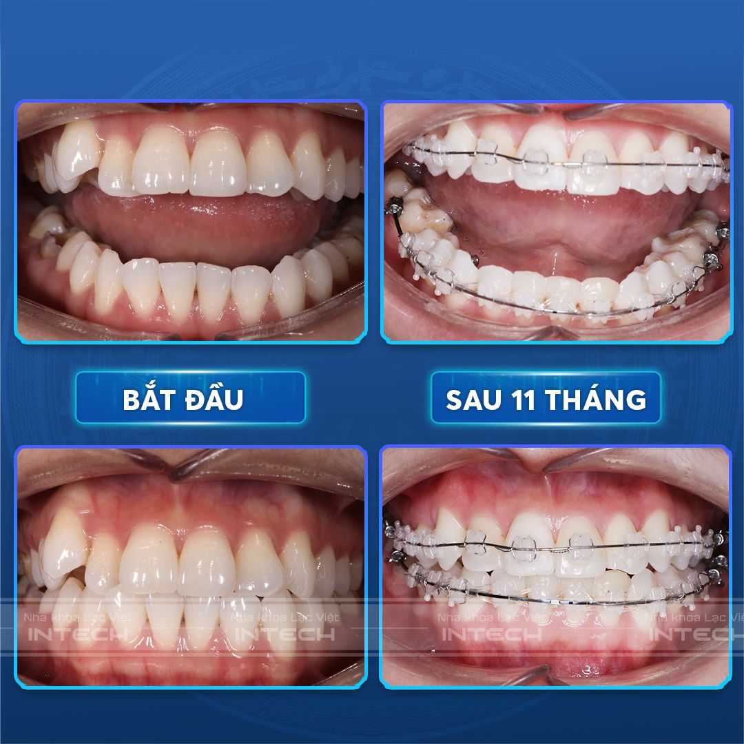 khac phuc rang bang phuong phap nieng rang su