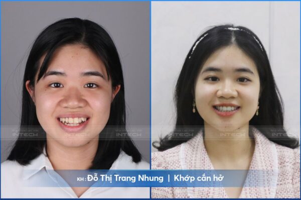 Khách hàng Đỗ Thị Trang Nhung hết khớp cắn hở sau 20 tháng niềng răng Khách hàng Đỗ Thị Trang Nhung hết khớp cắn hở sau 20 tháng niềng răng