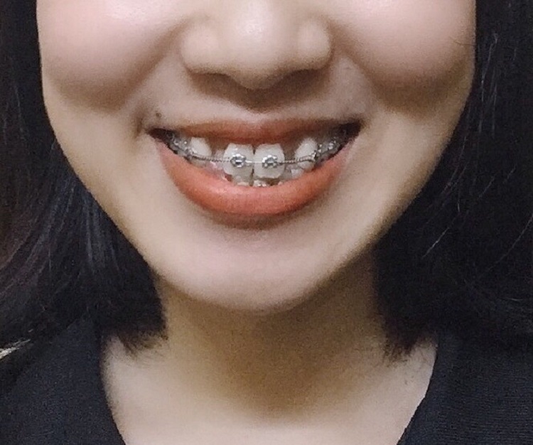 Khi gắn dây cung, răng bắt đầu dịch chuyển nên sẽ bị đau hơn 1 chút