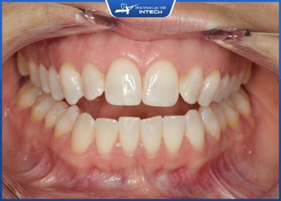 Khớp cắn hở - Một trong những tình trạng sai lệch khớp cắn nặng Khớp cắn hở - Một trong những tình trạng sai lệch khớp cắn nặng