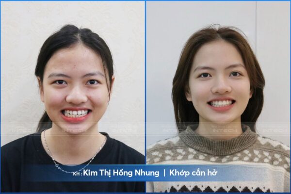 Khách hàng Kim Thị Hồng Nhung hết khớp cắn hở nhờ niềng răng công nghệ X - Matrix Khách hàng Kim Thị Hồng Nhung hết khớp cắn hở nhờ niềng răng công nghệ X - Matrix