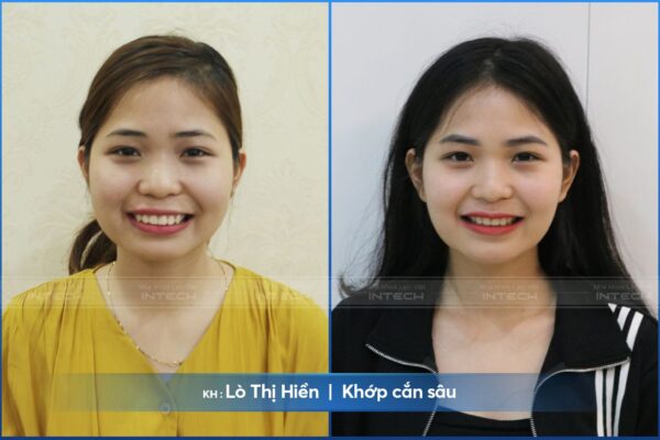 Khách hàng Lò Thị Hiền hết khớp cắn sâu sau 24 tháng niềng Khách hàng Lò Thị Hiền hết khớp cắn sâu sau 24 tháng niềng