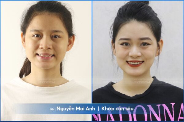 Mai Anh đã có hàm răng đều đẹp hết cắn sâu sau 20 tháng niềng Mai Anh đã có hàm răng đều đẹp hết cắn sâu sau 20 tháng niềng