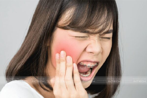 Niềng răng có thể xuất hiện những cơn đau ê ẩm do nhiều nguyên nhân khác nhau  Niềng răng có thể xuất hiện những cơn đau ê ẩm do nhiều nguyên nhân khác nhau