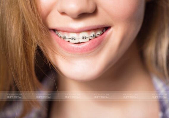 Niềng răng mắc cài kim loại khắc phục cằm lẹm do hô răng, răng mọc chìa.
