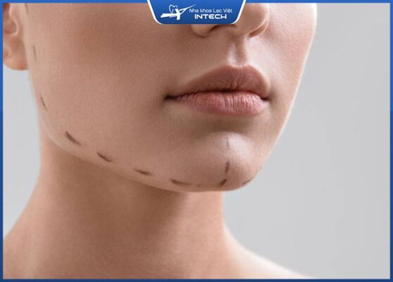 Phẫu thuật hàm giúp khắc phục triệt để sai khớp cắn do xương hàm Phẫu thuật hàm giúp khắc phục triệt để sai khớp cắn do xương hàm