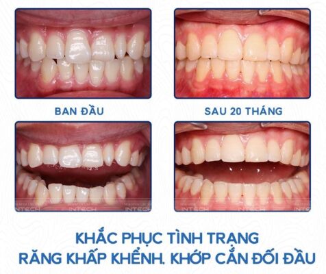 Thời gian niềng răng mặt trong có thể kéo dài từ 14 tới 24 tháng tùy theo tình trạng răng