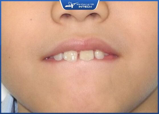 Thói quen mút môi ảnh hưởng tới khớp cắn của trẻ Thói quen mút môi ảnh hưởng tới khớp cắn của trẻ