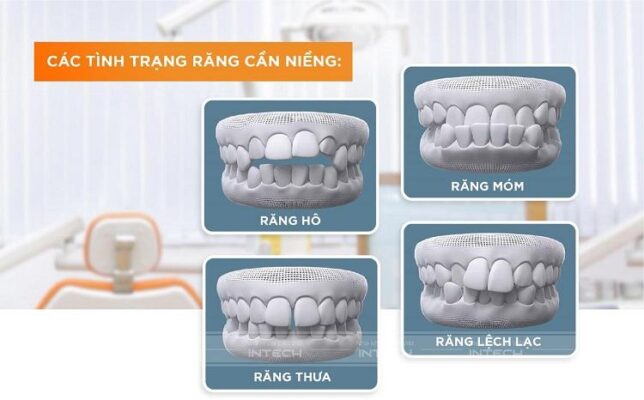 Niềng răng mặt trong mang lại hiệu quả với tất cả các mức độ sai lệch răng