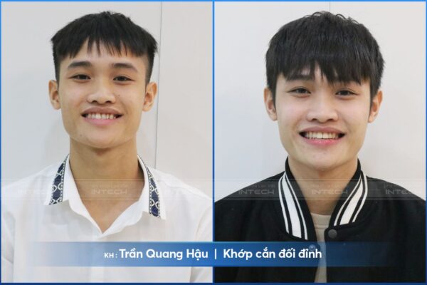 Khớp cắn về chuẩn sau 15 tháng niềng răng của Trần Quang Hậu Khớp cắn về chuẩn sau 15 tháng niềng răng của Trần Quang Hậu