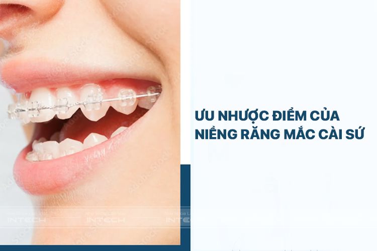 uu nhuoc diem nieng rang mac cai su