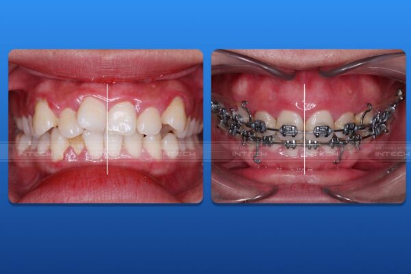 Tình trạng răng thay đổi nên bị lệch đường giữa 