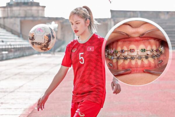 Tú Anh - Nữ cầu thủ U19 Việt Nam đang  niềng răng tại Lạc Việt Intech
