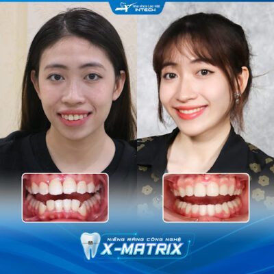 So sánh kết quả trước và sau khi niềng răng của Phương Thảo để thấy rõ sự khác biệt