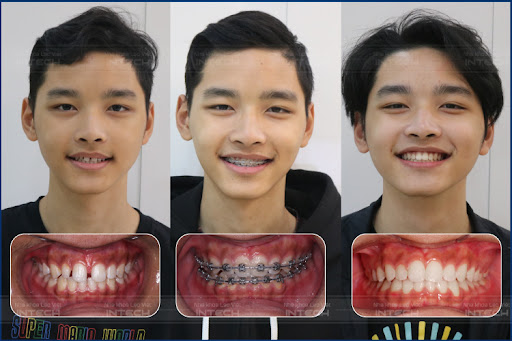 Hình ảnh trước và sau khi niềng răng thưa