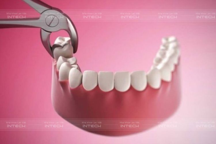 Nhổ răng tạo khoảng trong niềng răng