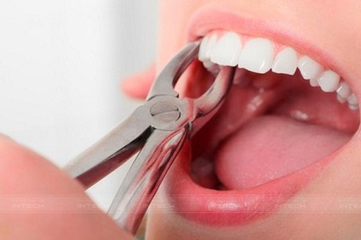 Nhổ răng áp dụng cho trường hợp diện tích cung hàm không đủ cho răng